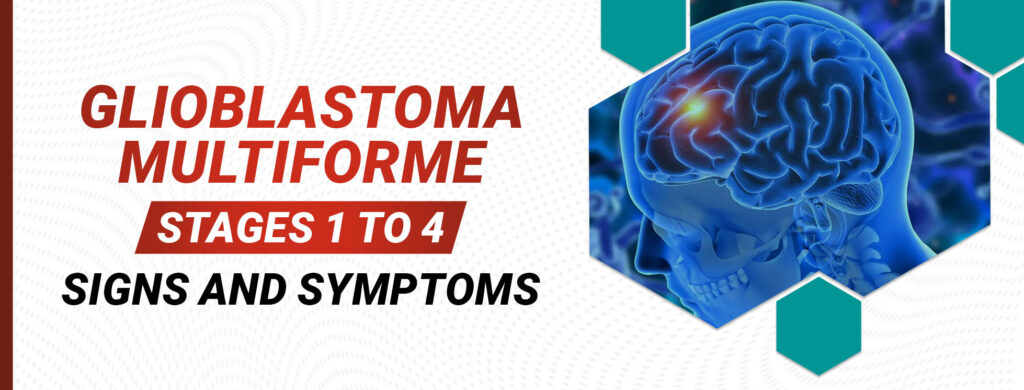 Glioblastoma Multiforme: Stages 1 To 4, Signs And Symptoms - Vydehi ...