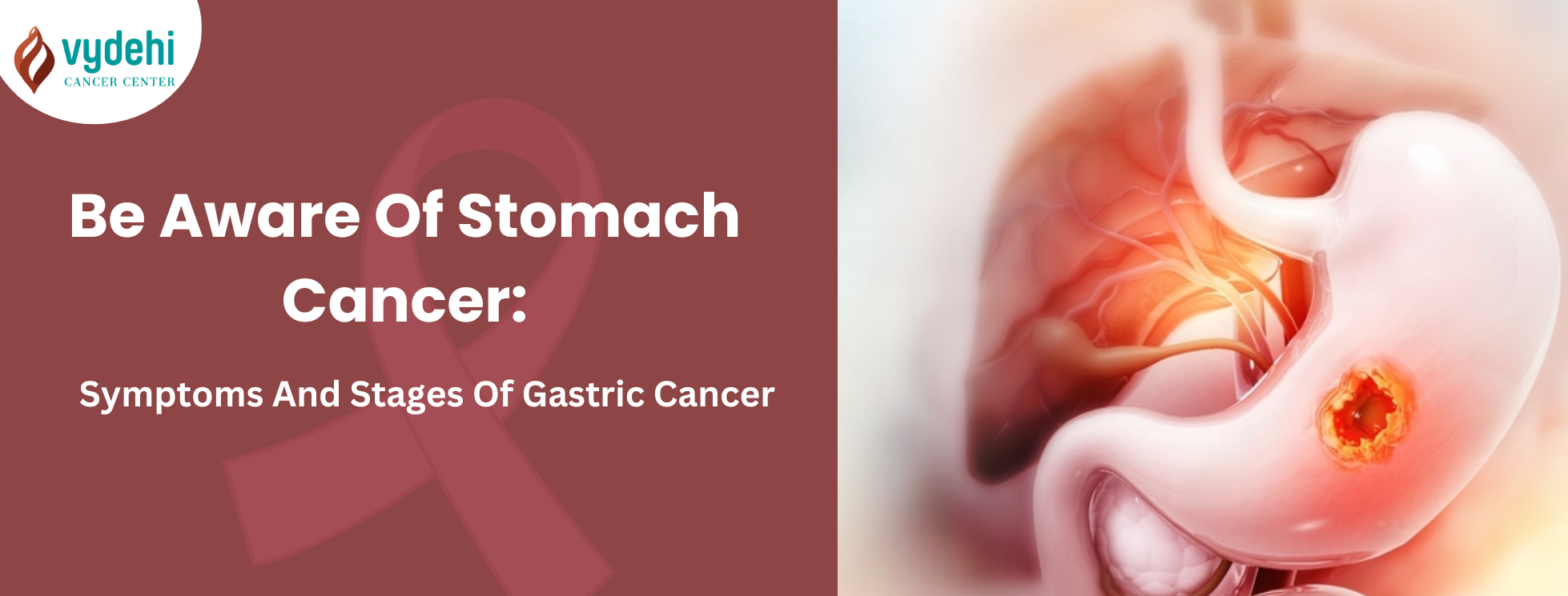 Stomach Cancer